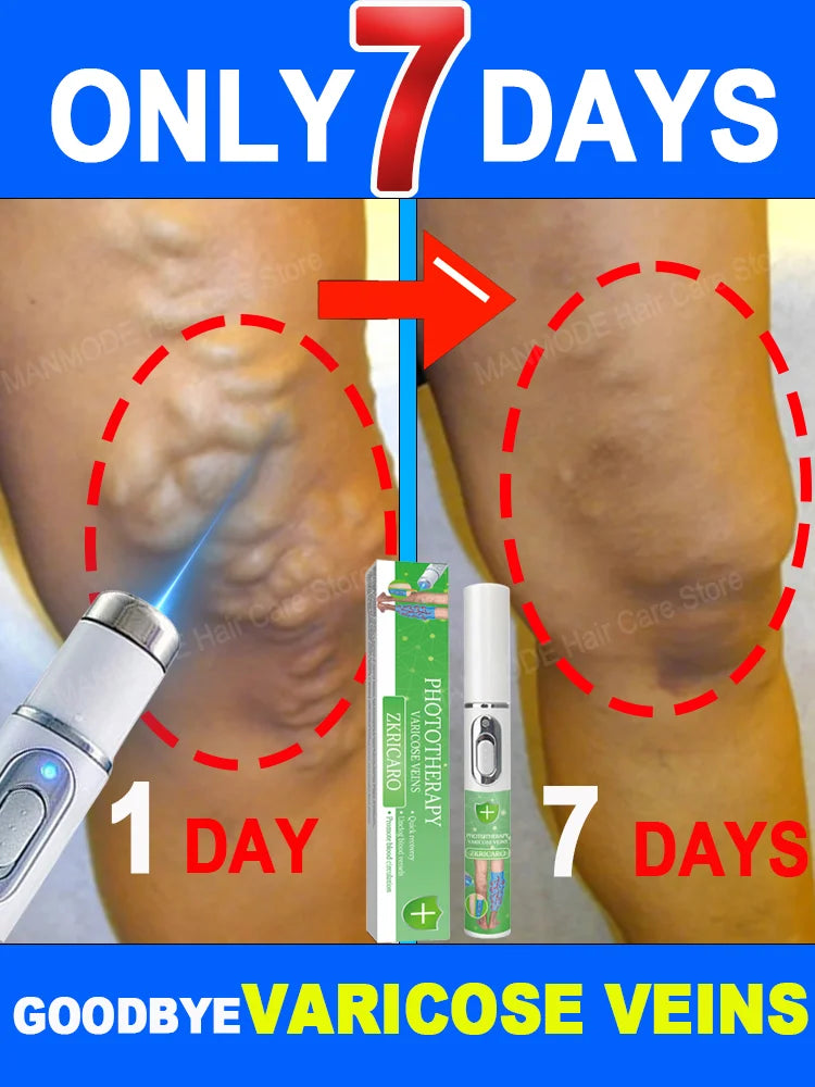 Powerful Laser Therapy venous inflammation sell like hot cakes