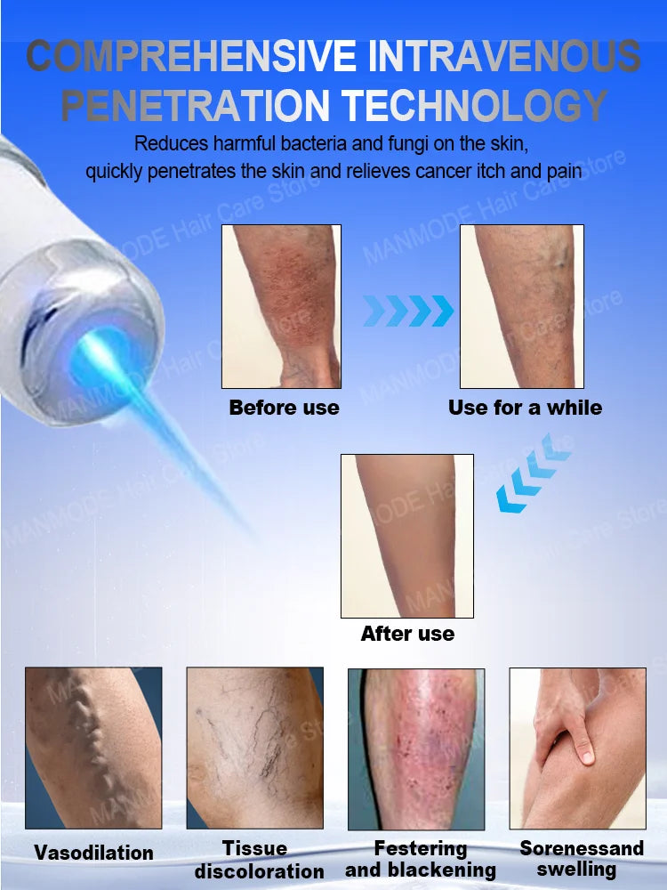Powerful Laser Therapy venous inflammation sell like hot cakes