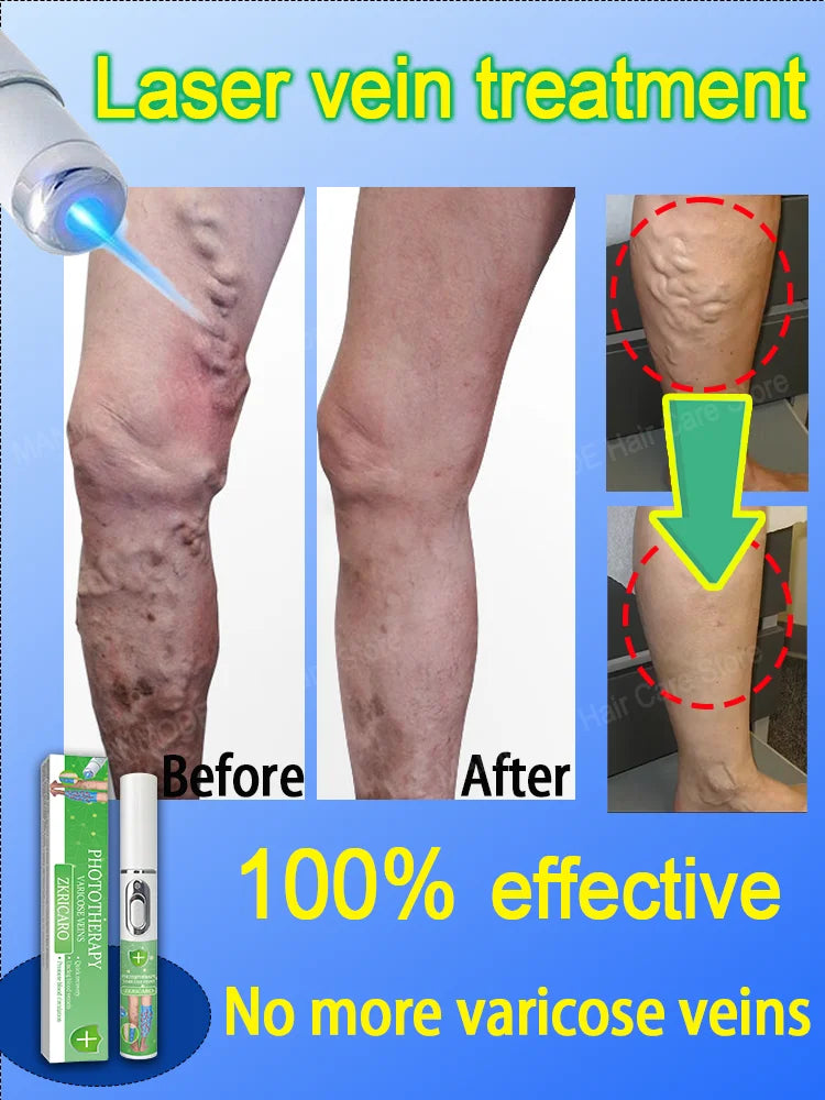 Powerful Laser Therapy venous inflammation sell like hot cakes