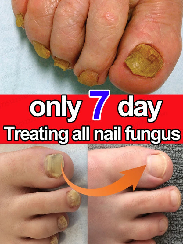 7 jours de réparation d'huile d'essence d'ongle, produits de soins pour l'onychomycose